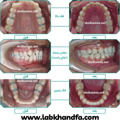 قبل و بعد نمونه کار مال اکلوژن کلاس I دکتر احمد شیبانی نیا