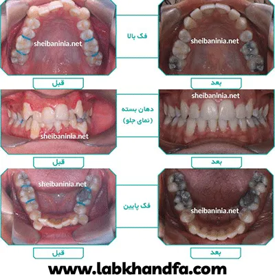 قبل و بعد نمونه کار درمان مال اکلوژن کلاس I دکتر احمد شیبانی نیا