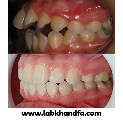 قبل و بعد نمونه کار درمان ناهنجاری های دهانی دکتر محمد مهدی فیروزبخت
