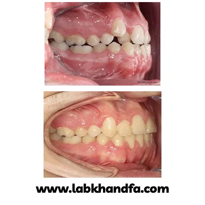 قبل و بعد نمونه کار ارتودنسی دکتر احسان صانعی شماره 2