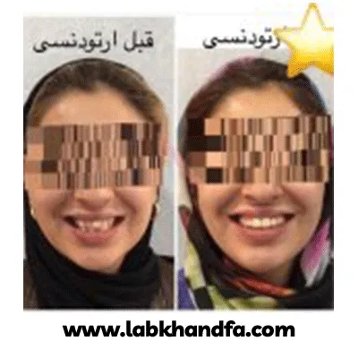 قبل و بعد نمونه کار ارتودنسی دکتر مهدی فهیمی