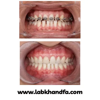 قبل و بعد نمونه کار ارتودنسی دکتر احسان صانعی