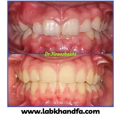 قبل و بعد نمونه کار ارتودنسی دکتر محمد مهدی فیروزبخت