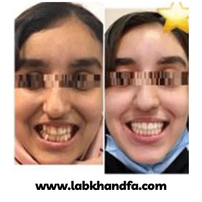 قبل و بعد نمونه کار ارتودنسی کودکان دکتر مهدی فهیمی