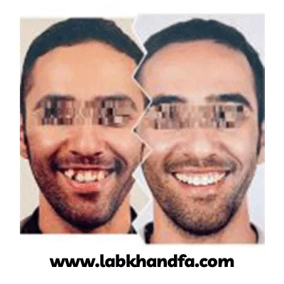 قبل و بعد درمان بی نظمی های شدید دندانی دکتر مهدی فهیمی