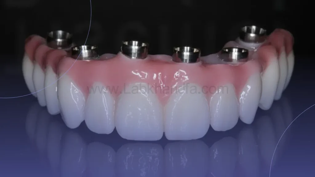 مراحل ایمپلنت فول ماوس