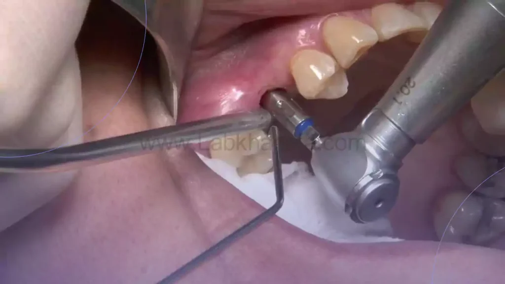 تصویر جراحی ایمپلنت دندان