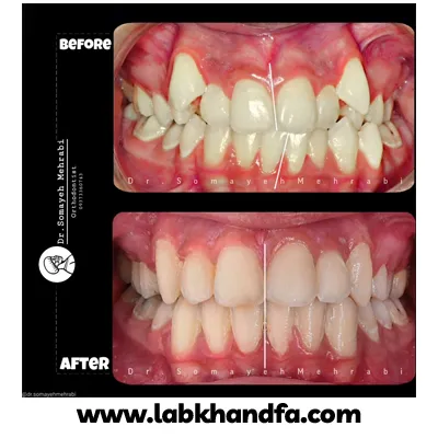 قبل و بعد نمونه کار ارتودنسی دکتر سمیه مهرابی