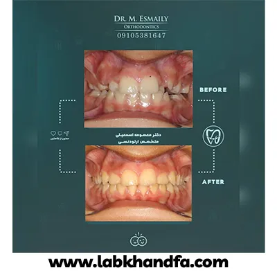 قبل و بعد نمونه کار ارتودنسی دکتر معصومه اسماعیلی