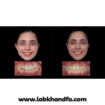 قبل و بعد نمونه کار ارتودنسی دکتر کوثر عزیزلو