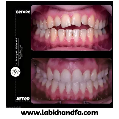 قبل و بعد نمونه کار درمان ارتودنسی دکتر سمیه مهرابی