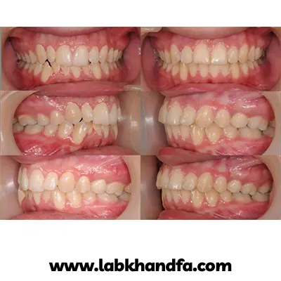 قبل و بعد نمونه کار درمان بی نظمی دندانی دکتر علیرضا جعفری نعیمی