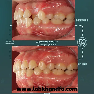 قبل و بعد نمونه کار دیگری از ارتودنسی دندان دکتر معصومه اسماعیلی