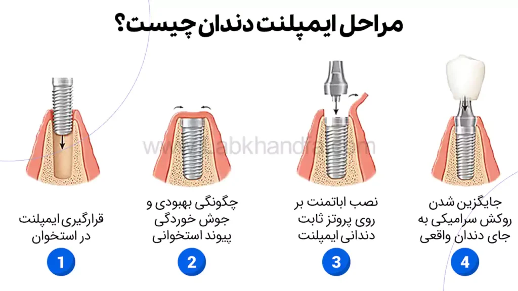 مراحل ایمپلنت دندان چیست؟