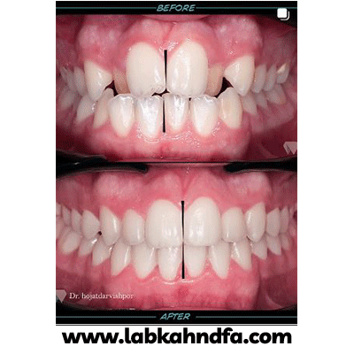 نمونه کار ارتودنسی دکتر حجت درویش پور کاخکی شماره 1