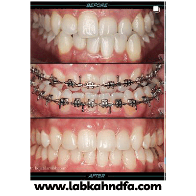 نمونه کار ارتودنسی دکتر حجت درویش پور کاخکی شماره 3