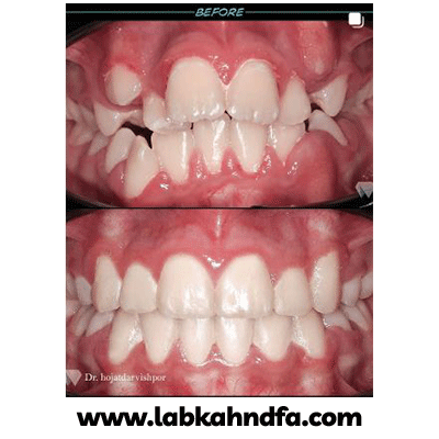 نمونه کار ارتودنسی دکتر حجت درویش پور کاخکی