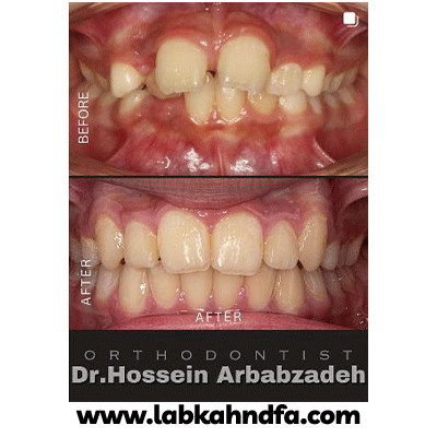 نمونه کار ارتودنسی دکتر حسبن ارباب زاده بروجنی
