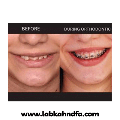 نمونه کار ارتودنسی دکتر حسین ارباب زاده بروجنی شماره 1