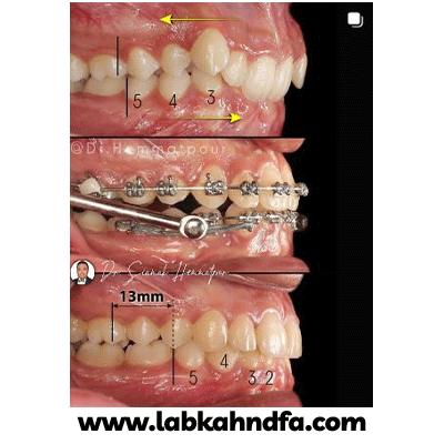 نمونه کار ارتودنسی دکتر سیامک همت پور شماره 2