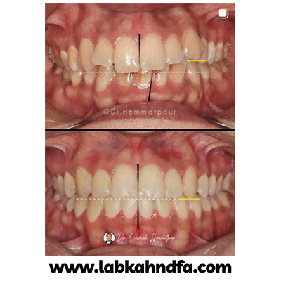 نمونه کار ارتودنسی دکتر سیامک همت پور