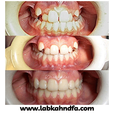 نمونه کار ارتودنسی دکتر علی حیدری شماره 1