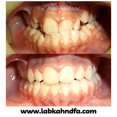 نمونه کار ارتودنسی دکتر علی حیدری