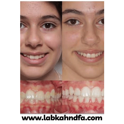 نمونه کار ارتودنسی دکتر محمد فراهانی