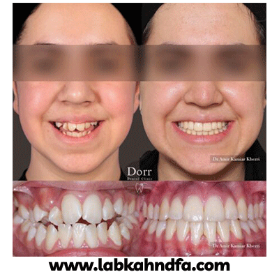 نمونه کار ارتودنسی دکتر کامیار خضری شماره 1