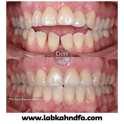 نمونه کار ارتودنسی دکتر کامیار خضری