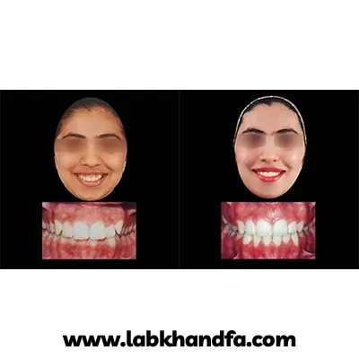 نمونه کار ارتودنسی دکتر کوثر عزیزلو