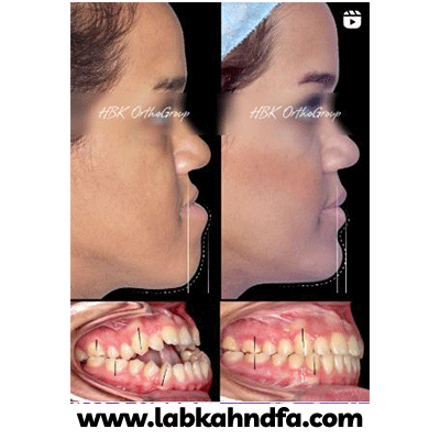 نمونه کار ارتودنسی سیامک همت پور شماره 1