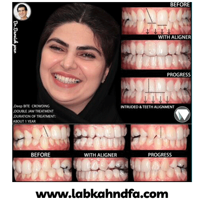 نمونه کار ارتودنسی نامرئی دکتر هادی درویش پور