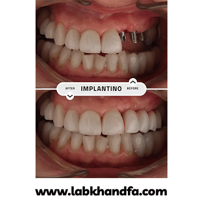 نمونه کار ایمپلنت دکتر شیرین شیدفر شماره 1