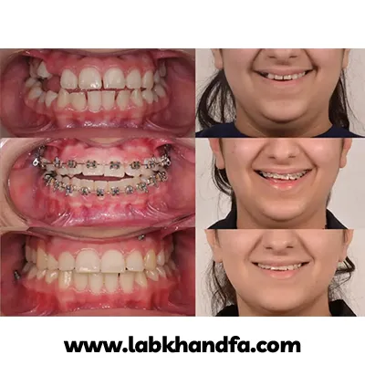 نمونه کار درمان ارتودنسی دکتر علیرضا جعفری نعیمی