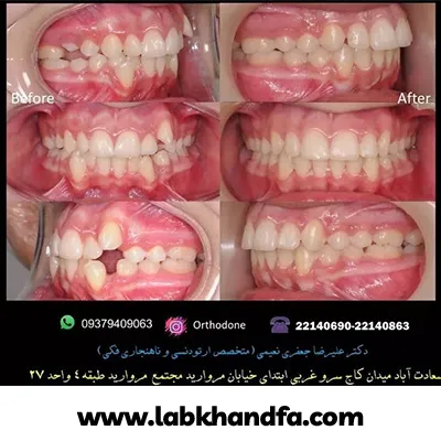 نمونه کار دیگری از درمان ارتودنسی دکتر علیرضا جعفری نعیمی