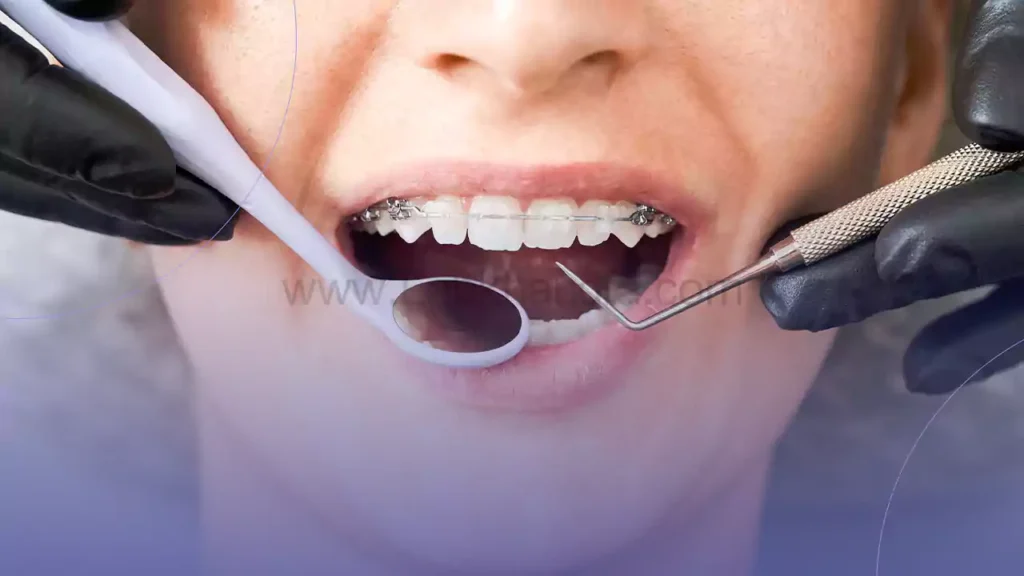 براکت های شفاف ارتودنسی سرامیکی