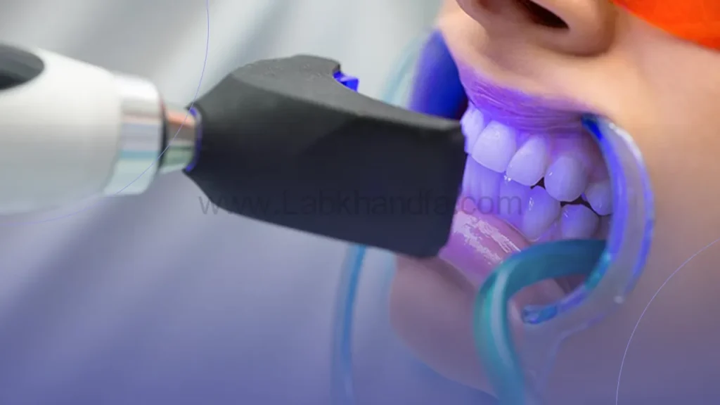 عکس بلیچینگ دندان در مطب
