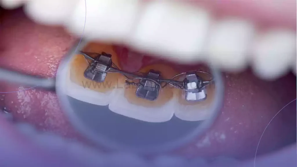 عکسی از بریس های ارتودنسی لینگوال