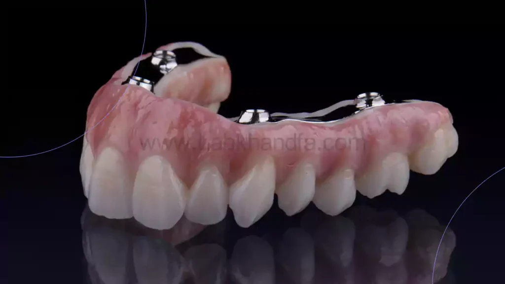 اوردنچر متکی بر ایمپلنت