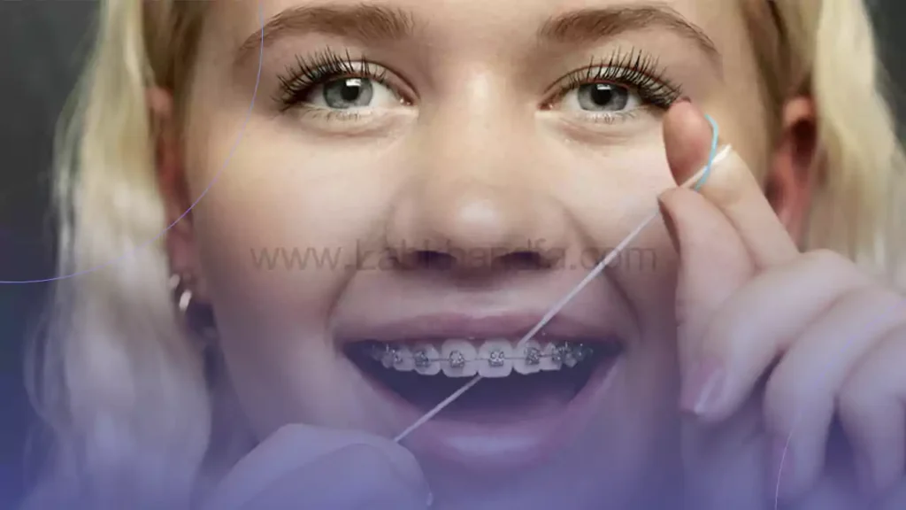 عکس از نخ دندان کشیدن یک خانم دارای براکت های ارتودنسی ثابت