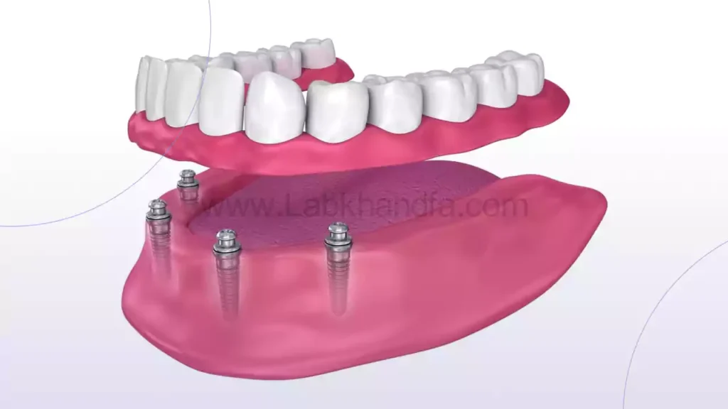 عکس اوردنچر