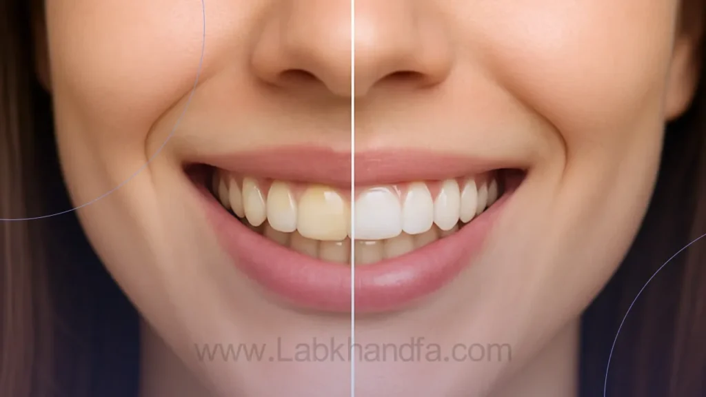 عکس قبل و بعد بلیچینگ دندان