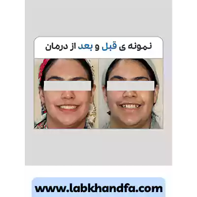 نمونه کار قبل و بعد درمان ارتودنسی دندان دکتر سهیل سالاری