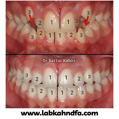 نمونه کار ارتودنسی دکتر ستار کبیری شماره 2