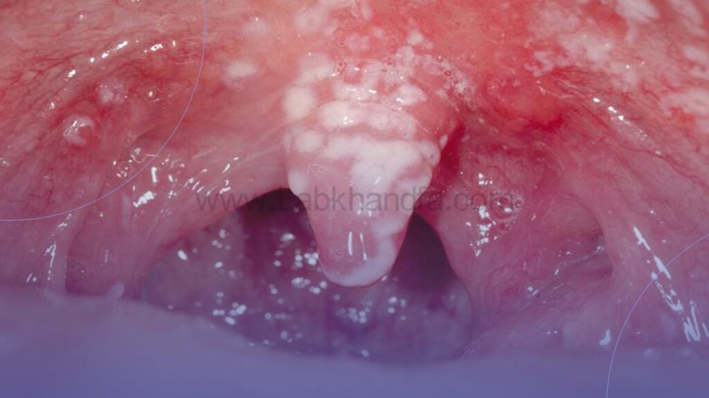 عکس برفک دهان