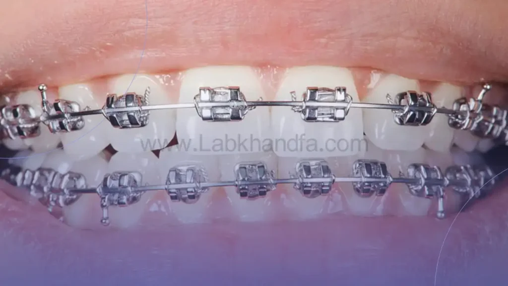 ارتودنسی ثابت