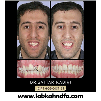 نمونه کار ارتودنسی دکتر ستار کبیری شماره 1