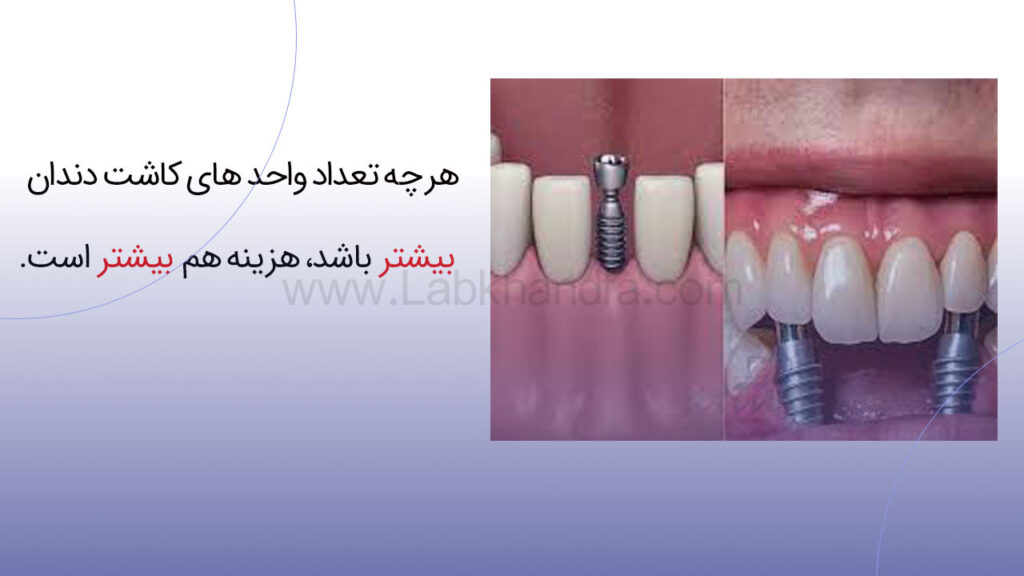 هزینه ایمپلنت بر اساس تعداد واحدهای کاشته شده