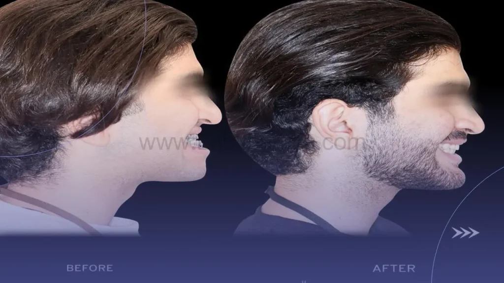 تاثیر ارتودنسی بر گونه ها 